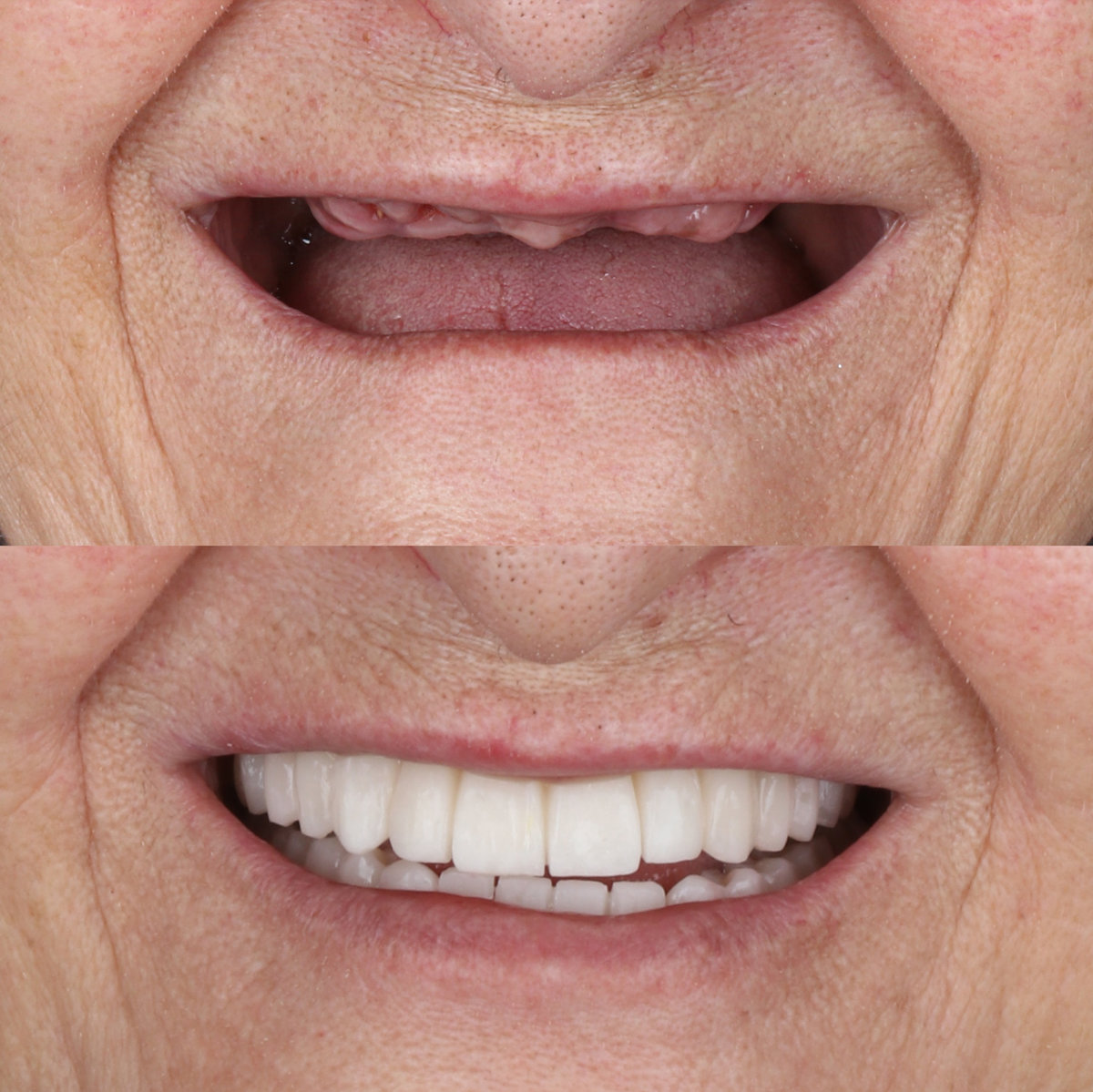 Full-arch denture prosthesis with dental implants placed in the jawbone.