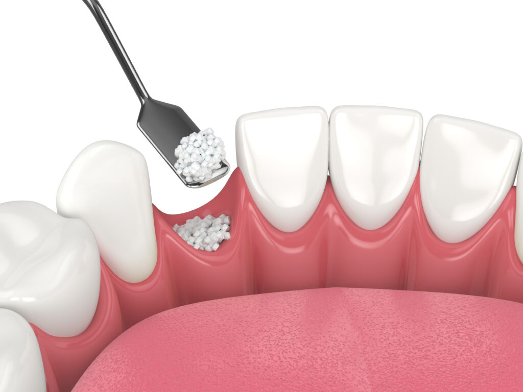 3D render of dental bone grafting with dental bone biomaterial over white background. Jaw bone augmentation procedure concept.