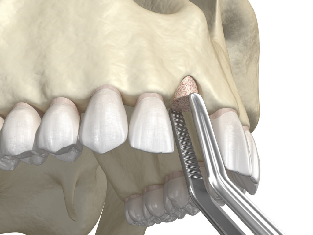 Bone grafting- augmentation using ring method, tooth implantation. Medically accurate 3D illustration