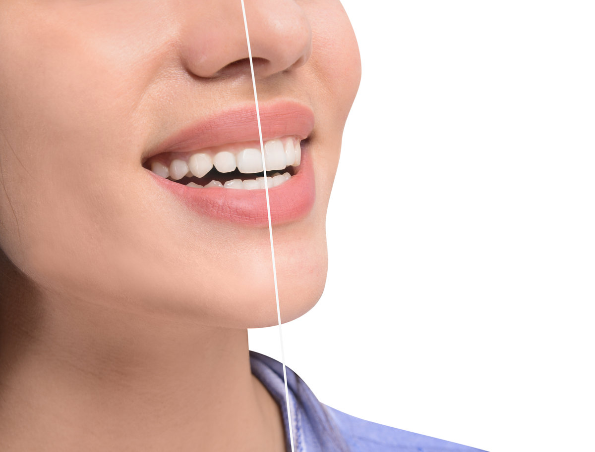Young woman before and after procedure of gingival plasty on white background, closeup