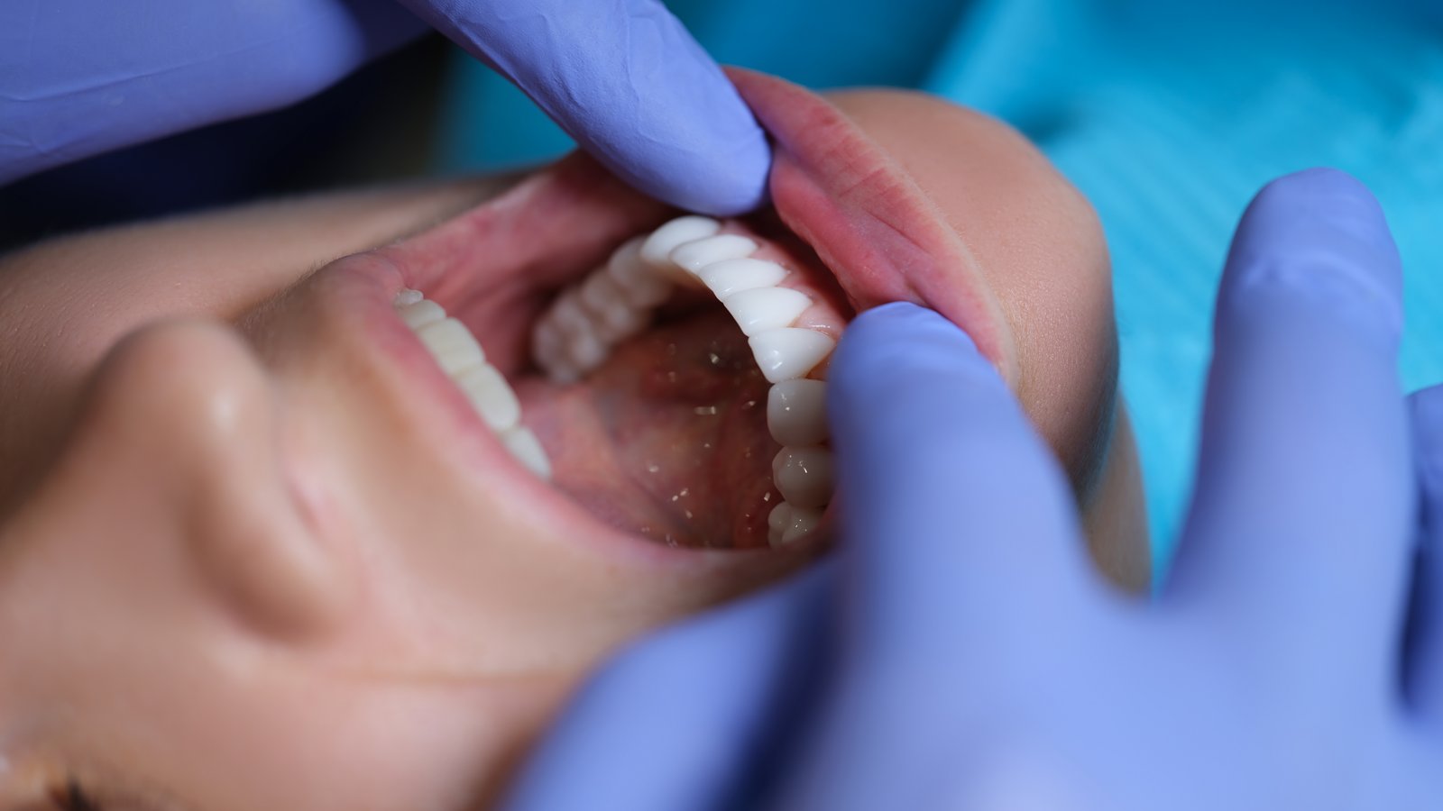 Dentist examining a patient during a routine oral cancer screening