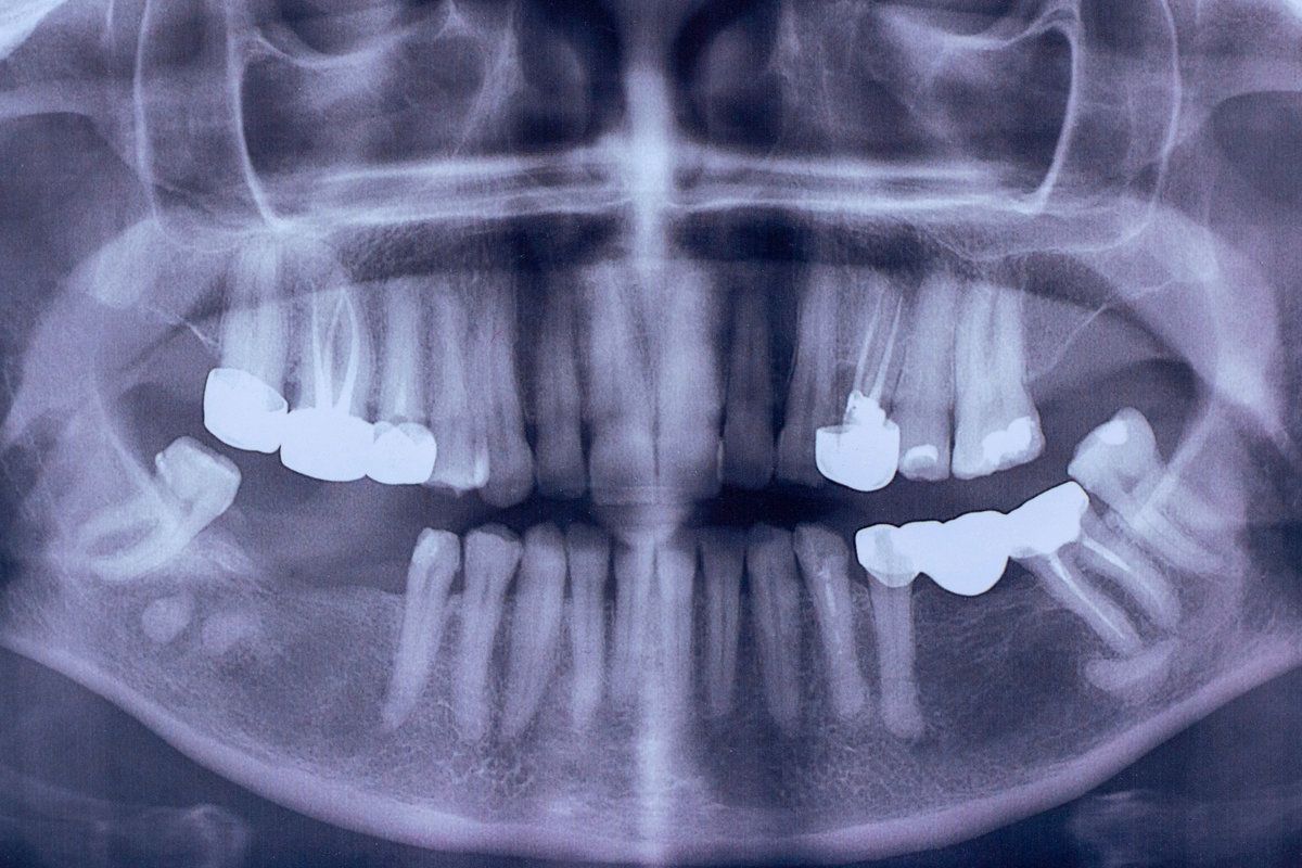 Signs You May Need a Bone Density Test Before Getting Implants - Ponce ...